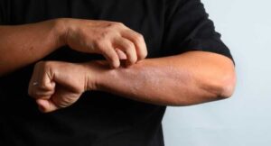 Egzama (Atopik Dermatit) İçin Hangi Bölüme/Doktora Gidilmeli?