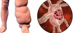 Fil Hastalığı (Lenfödem) Nedir? Nasıl Tedavi Edilir?