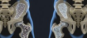 Osteoporoz nedir? Nasıl tedavi edilir?