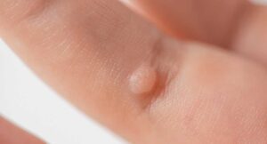 Siğiller İçin Hangi Bölüme/Doktora Gidilmeli?