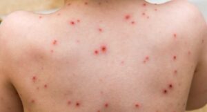 Suçiçeği İçin Hangi Bölüme/Doktora Gidilir?