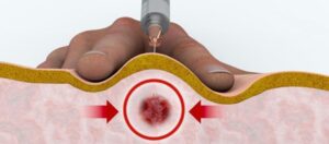 Tetik nokta enjeksiyonu nedir? Nasıl yapılır?