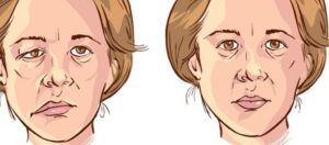 Yüz Felci Nedir, Belirtileri Nelerdir?